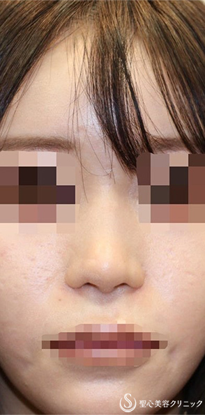 【20代女性・ポリービーク変形・アップノーズを改善し美人鼻に】鼻中隔延長術（肋軟骨）＋鼻尖形成（肋軟骨）＋プロテーゼ入替（術後1週間) Before 