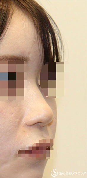 【20代女性・ポリービーク変形・アップノーズを改善し美人鼻に】鼻中隔延長術（肋軟骨）＋鼻尖形成（肋軟骨）＋プロテーゼ入替（術後1週間) Before 