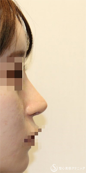 【20代女性・ポリービーク変形・アップノーズを改善し美人鼻に】鼻中隔延長術（肋軟骨）＋鼻尖形成（肋軟骨）＋プロテーゼ入替（術後1週間) After 