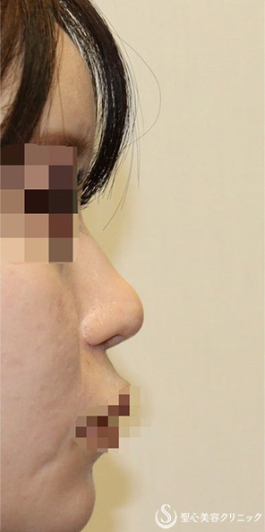 【20代女性・ポリービーク変形・アップノーズを改善し美人鼻に】鼻中隔延長術（肋軟骨）＋鼻尖形成（肋軟骨）＋プロテーゼ入替（術後1週間) Before 