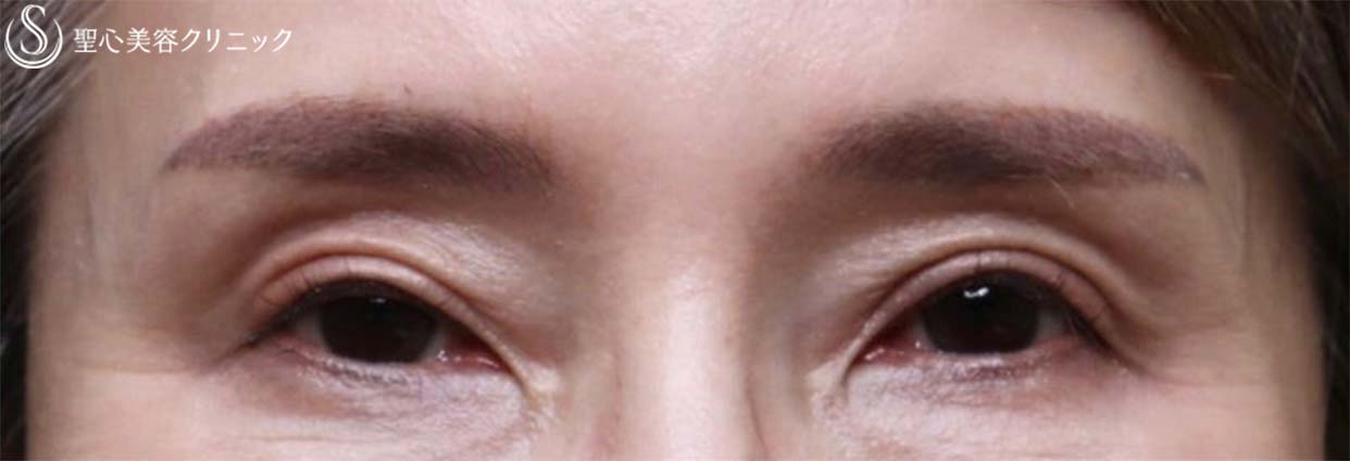 【50代女性・目の上の凹み（サンケンアイ）を改善してお若く】プレミアムPRP皮膚再生療法（施術後3ヶ月） Before 