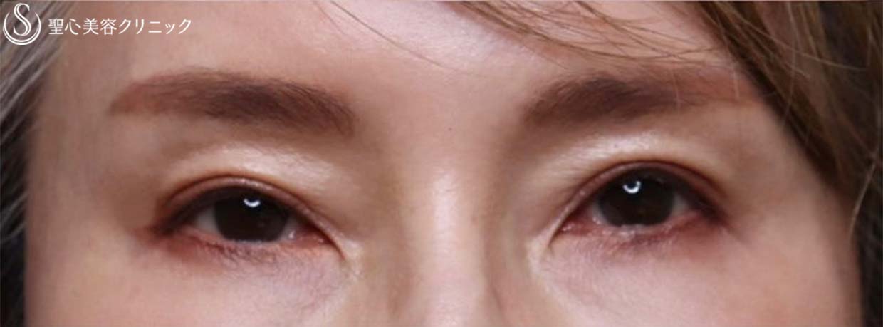 【50代女性・目の上の凹み（サンケンアイ）を改善してお若く】プレミアムPRP皮膚再生療法（施術後3ヶ月） After 