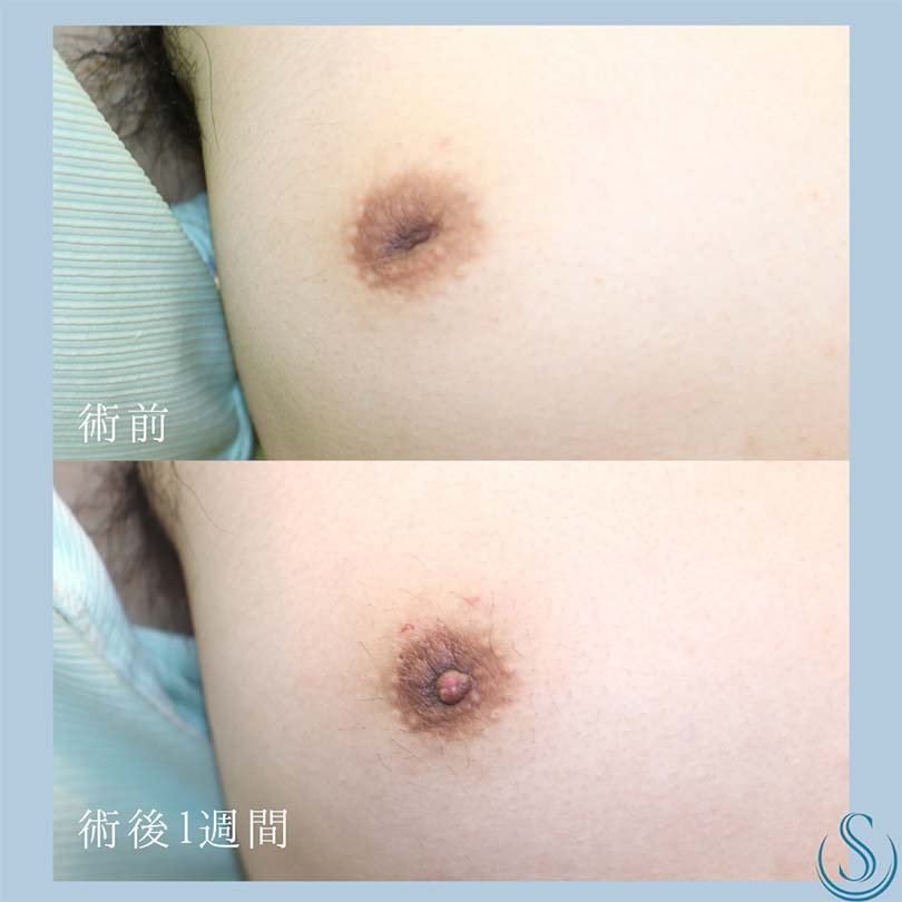 【20代男性・陥没乳頭を整える】陥没乳頭（陥没乳首）（1ヶ月後） Before 
