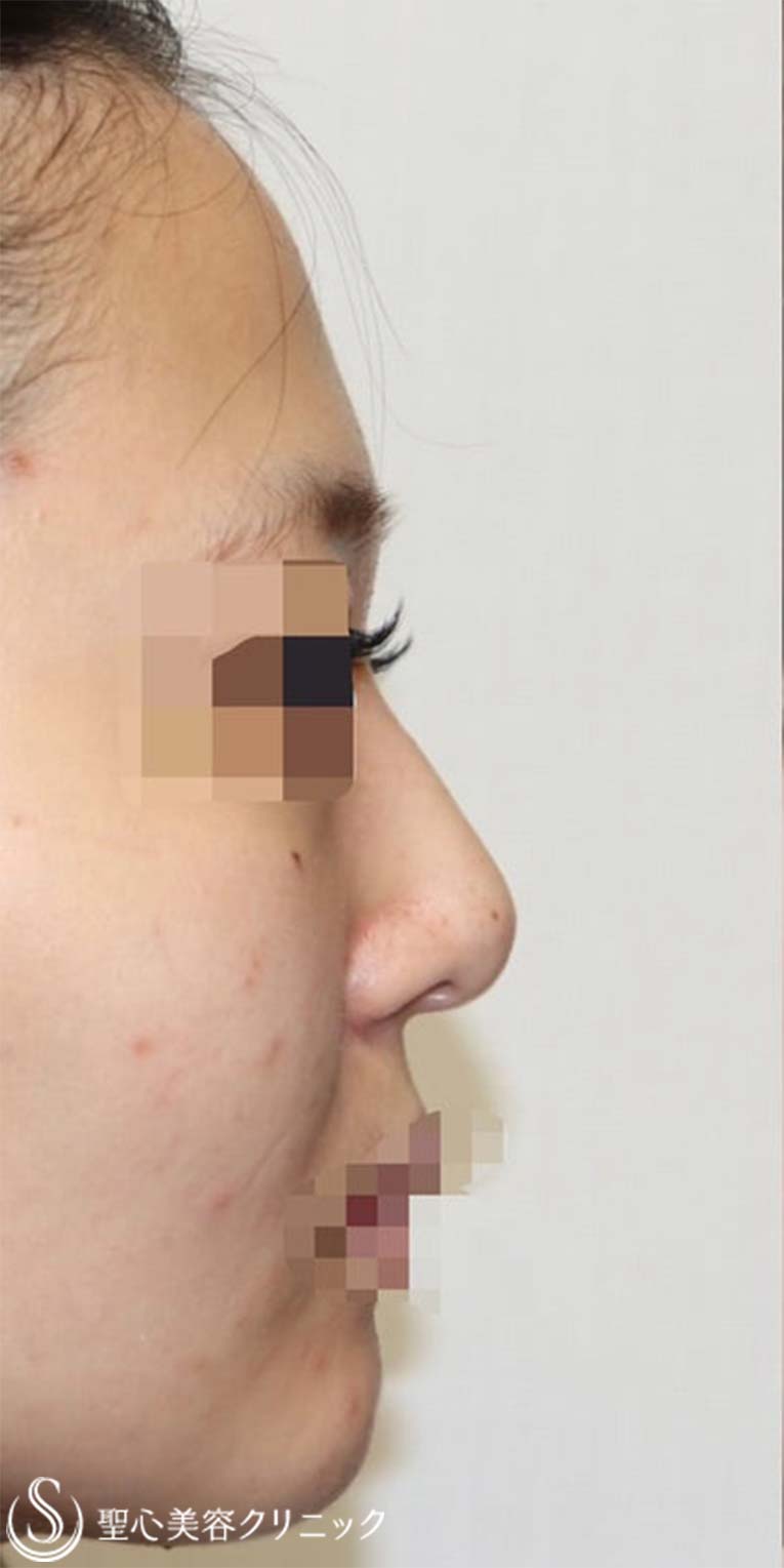 【20代女性・鼻を綺麗にツンも改善】鼻中隔延長術（肋軟骨）＋鼻尖形成（肋軟骨）＋プロテーゼ（術後1週間） Before 