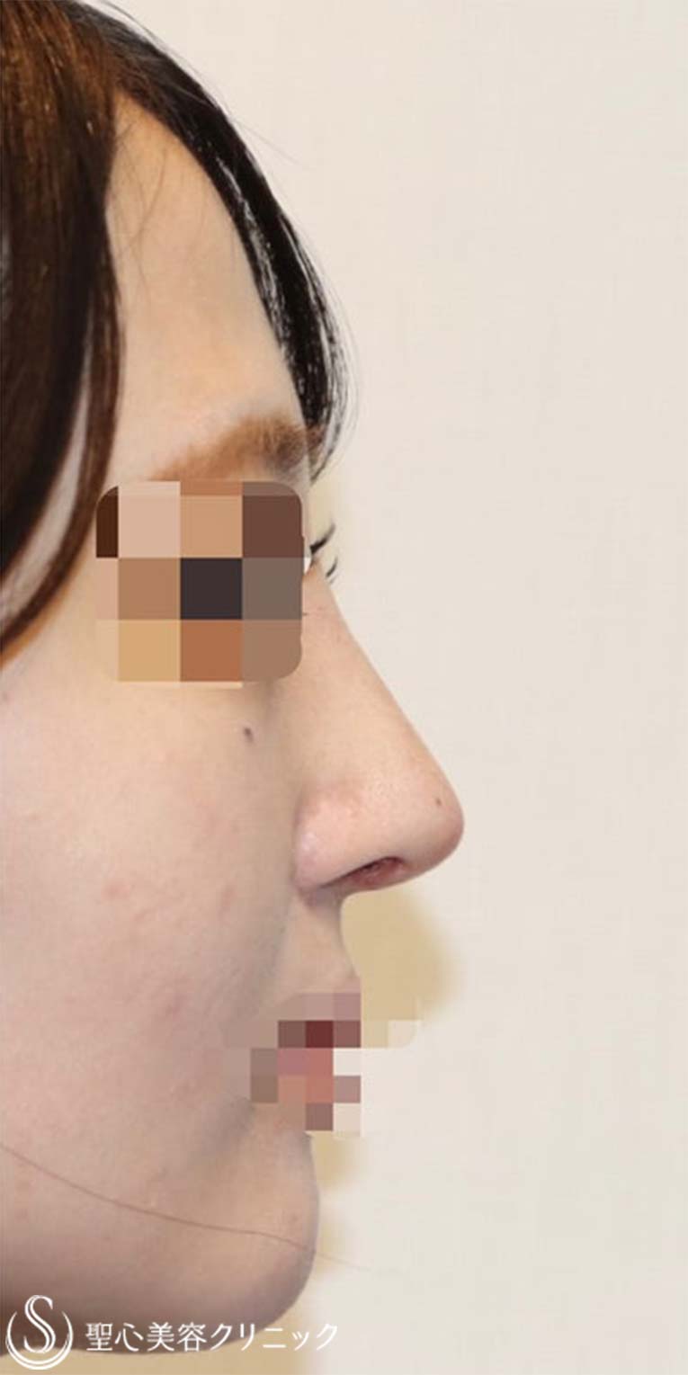 【20代女性・鼻を綺麗にツンも改善】鼻中隔延長術（肋軟骨）＋鼻尖形成（肋軟骨）＋プロテーゼ（術後1週間） After 