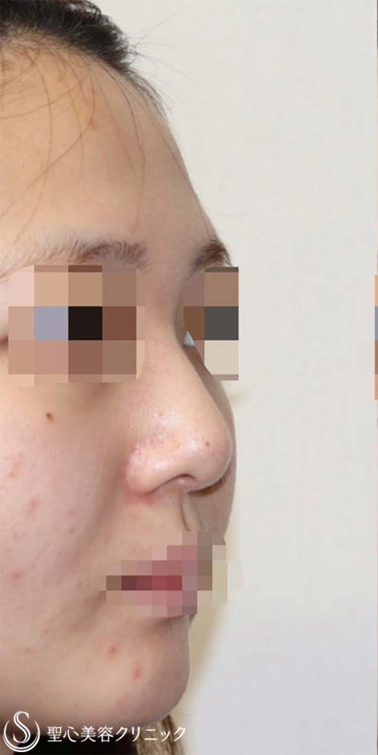 【20代女性・鼻を綺麗にツンも改善】鼻中隔延長術（肋軟骨）＋鼻尖形成（肋軟骨）＋プロテーゼ（術後1週間） Before 
