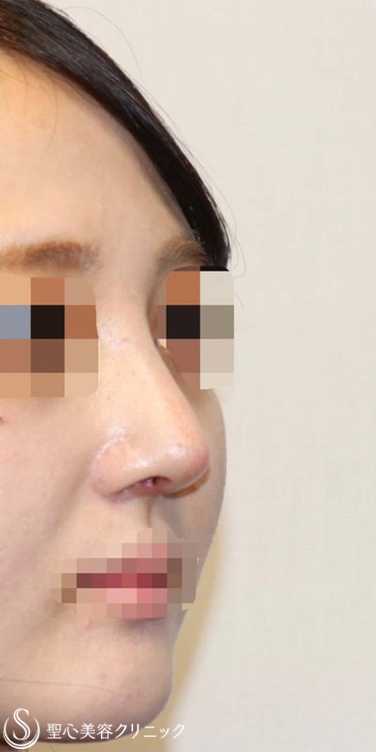 【20代女性・鼻を綺麗にツンも改善】鼻中隔延長術（肋軟骨）＋鼻尖形成（肋軟骨）＋プロテーゼ（術後1週間） After 