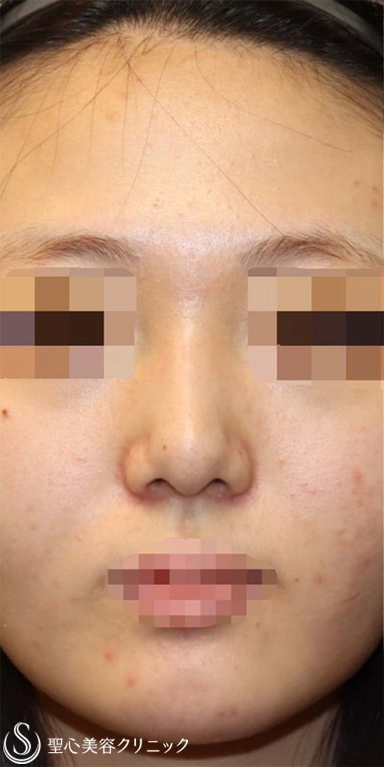 【20代女性・鼻を綺麗にツンも改善】鼻中隔延長術（肋軟骨）＋鼻尖形成（肋軟骨）＋プロテーゼ（術後1週間） Before 