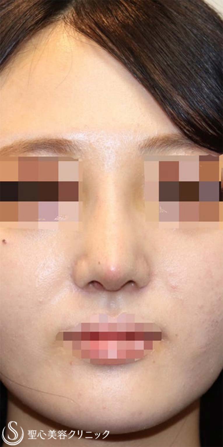 【20代女性・鼻を綺麗にツンも改善】鼻中隔延長術（肋軟骨）＋鼻尖形成（肋軟骨）＋プロテーゼ（術後1週間） After 