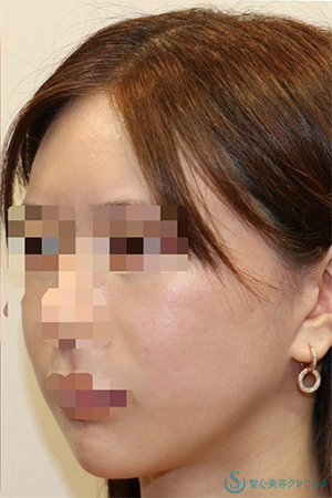 【20代女性・フェイスラインをシュッと】「フェイスリフト手術」＋「頬の脂肪吸引」＋「リガメント処置」(術後1年2ヶ月) After 