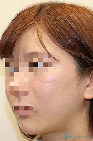 【20代女性・フェイスラインをシュッと】「フェイスリフト手術」＋「頬の脂肪吸引」＋「リガメント処置」(術後1年2ヶ月) Before 