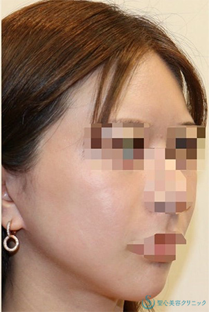 【20代女性・フェイスラインをシュッと】「フェイスリフト手術」＋「頬の脂肪吸引」＋「リガメント処置」(術後1年2ヶ月) After 
