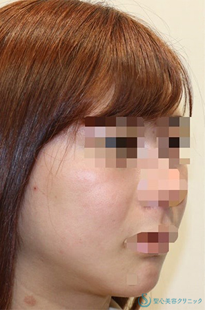 【20代女性・フェイスラインをシュッと】「フェイスリフト手術」＋「頬の脂肪吸引」＋「リガメント処置」(術後1年2ヶ月) Before 