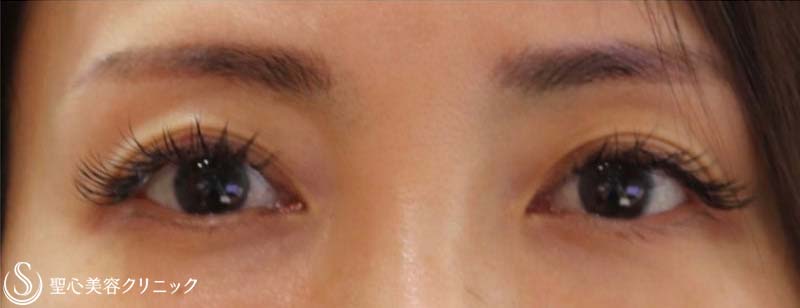 【50代女性・こだわりの眉下切開】眉下リフト（眉下切開） (術後1年) After 