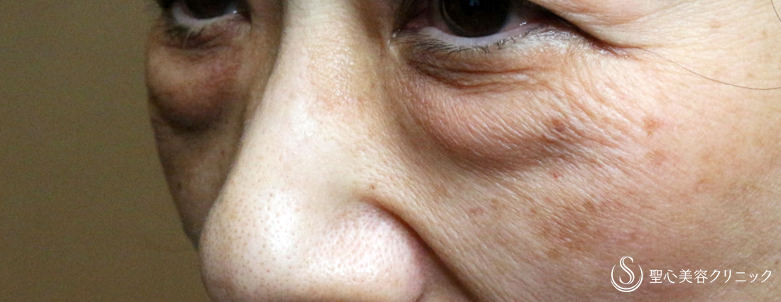 【60代女性・大きな目袋とタルミ】表ハムラ+α法「Ver.2」→外反修正→注入補正（4年後） Before 