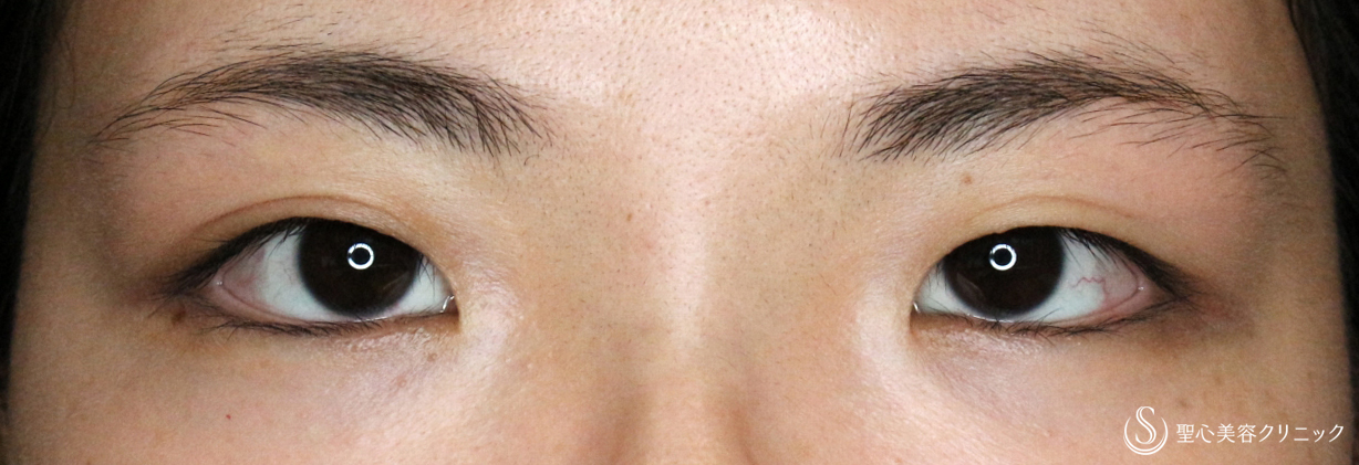 【20代女性・目頭切開だけで二重までくっきり】目頭切開+α法 単独（3年後） Before 