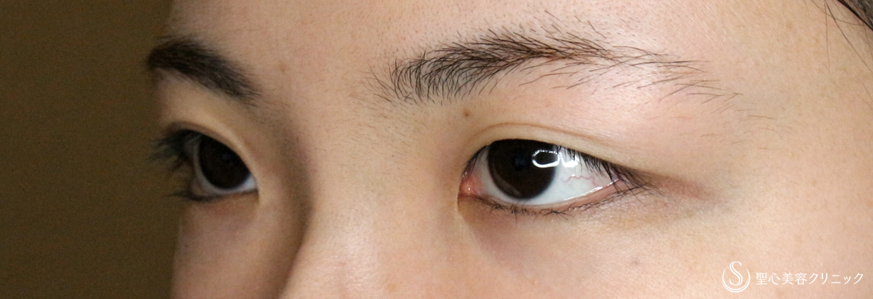 【20代女性・目頭切開だけで二重までくっきり】目頭切開+α法 単独（3年後） Before 