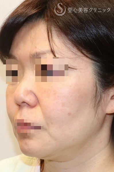 【40代女性・しっかりリフトアップ】フェイスリフト手術  (術後半年） Before 