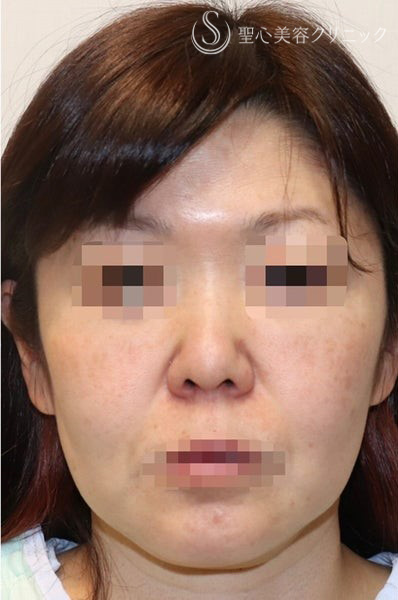 【40代女性・しっかりリフトアップ】フェイスリフト手術  (術後半年） Before 