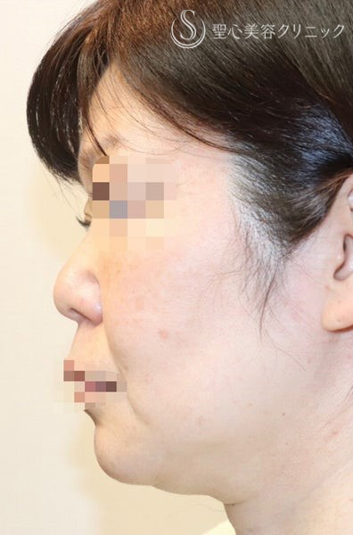 【40代女性・しっかりリフトアップ】フェイスリフト手術  (術後半年） Before 