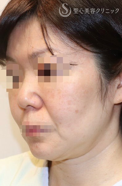 【40代女性・しっかりリフトアップ】フェイスリフト手術  (術後半年） Before 
