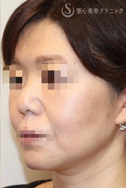 【40代女性・しっかりリフトアップ】フェイスリフト手術  (術後半年） After 