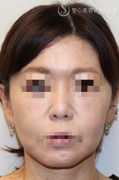 【40代女性・しっかりリフトアップ】フェイスリフト手術  (術後半年） After 