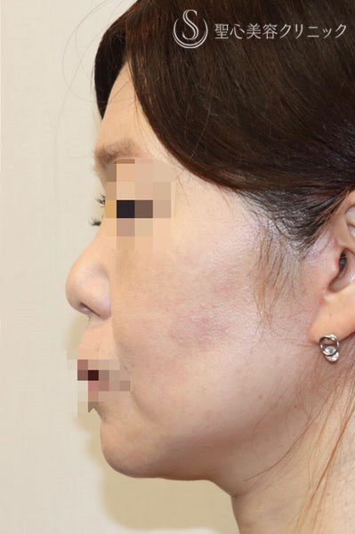 【40代女性・しっかりリフトアップ】フェイスリフト手術  (術後半年） After 