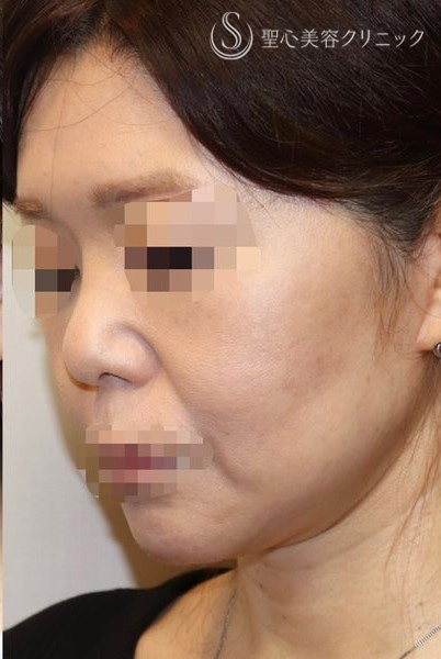 【40代女性・しっかりリフトアップ】フェイスリフト手術  (術後半年） After 