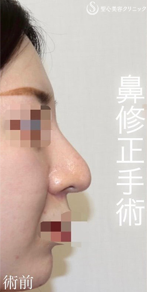 【20代女性・バランスを整えて綺麗かつ目立たないお鼻に】 「鼻中隔延長術（肋軟骨）」＋「鼻尖形成（肋軟骨）」＋「プロテーゼ入替」（術後１ヶ月） Before 