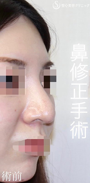 【20代女性・バランスを整えて綺麗かつ目立たないお鼻に】 「鼻中隔延長術（肋軟骨）」＋「鼻尖形成（肋軟骨）」＋「プロテーゼ入替」（術後１ヶ月） Before 