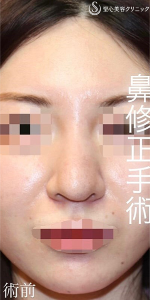 【20代女性・バランスを整えて綺麗かつ目立たないお鼻に】 「鼻中隔延長術（肋軟骨）」＋「鼻尖形成（肋軟骨）」＋「プロテーゼ入替」（術後１ヶ月） Before 