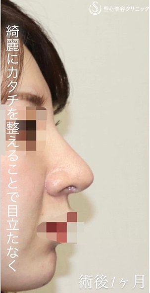 【20代女性・バランスを整えて綺麗かつ目立たないお鼻に】 「鼻中隔延長術（肋軟骨）」＋「鼻尖形成（肋軟骨）」＋「プロテーゼ入替」（術後１ヶ月） After 
