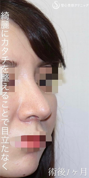 【20代女性・バランスを整えて綺麗かつ目立たないお鼻に】 「鼻中隔延長術（肋軟骨）」＋「鼻尖形成（肋軟骨）」＋「プロテーゼ入替」（術後１ヶ月） After 
