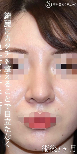【20代女性・バランスを整えて綺麗かつ目立たないお鼻に】 「鼻中隔延長術（肋軟骨）」＋「鼻尖形成（肋軟骨）」＋「プロテーゼ入替」（術後１ヶ月） After 