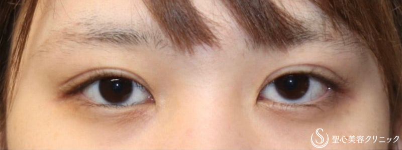 【20代女性・目頭のカタチを綺麗に、逆さまつ毛も修正】目頭切開・逆さまつ毛手術 （術後3ヶ月） Before 