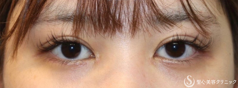 【20代女性・目頭のカタチを綺麗に、逆さまつ毛も修正】目頭切開・逆さまつ毛手術 （術後3ヶ月） After 