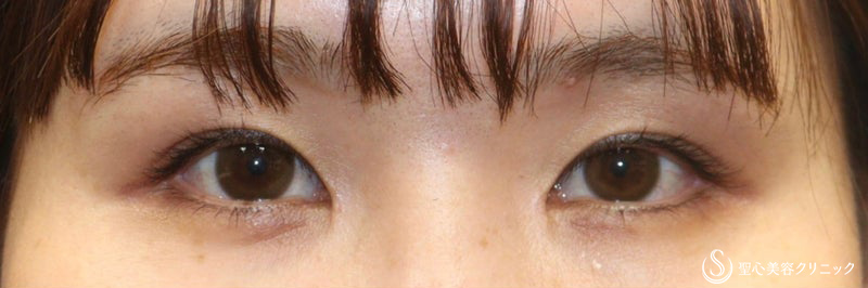 【20代女性・生まれつきかのような平行二重を】二重全切開 ＋目上切開 （術後７ヶ月） Before 