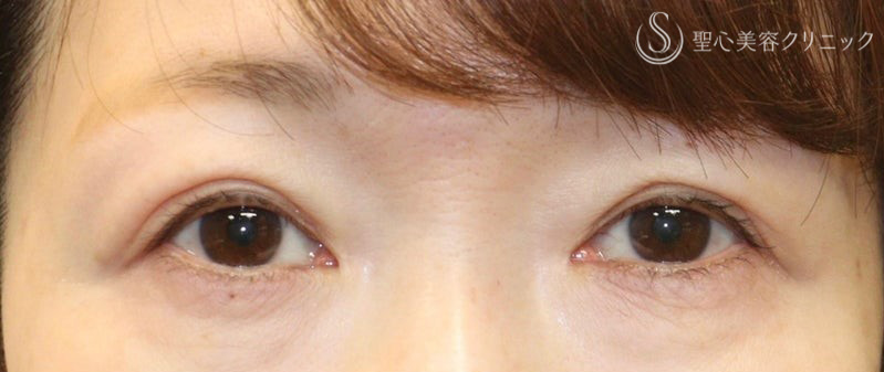 【50代女性・埋没による二重をさらに自然な二重に！】二重全切開（術後3ヶ月） Before 