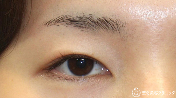 【20代女性・まぶたの重さが改善し、優しい平行二重に 】眉下切開＋目上切開（術後1ヶ月） Before 