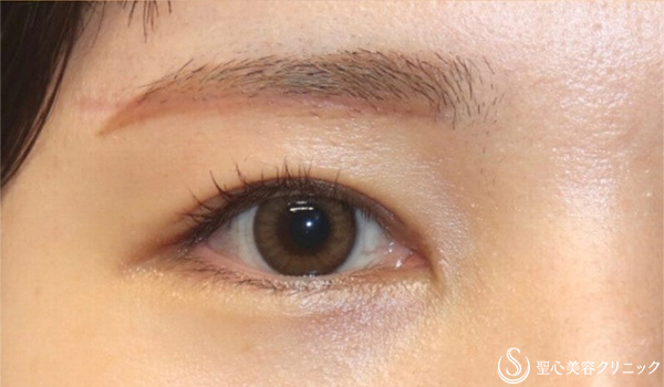 【20代女性・まぶたの重さが改善し、優しい平行二重に 】眉下切開＋目上切開（術後1ヶ月） After 