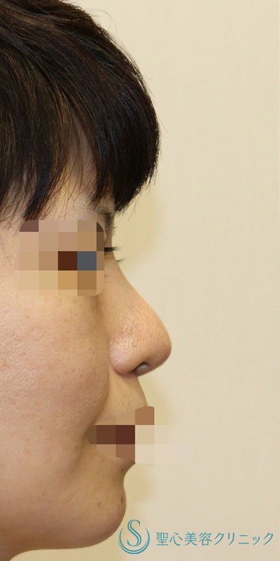 【40代女性・皮膚が厚く硬い方も綺麗にスッキリと】鼻中隔延長術（肋軟骨）＋鼻尖形成（肋軟骨）＋プロテーゼ（他院プロテーゼ入替）（術後7ヶ月） Before 
