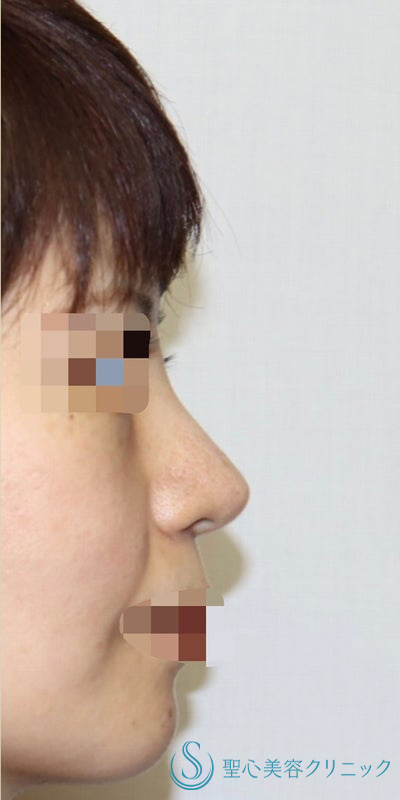 【40代女性・皮膚が厚く硬い方も綺麗にスッキリと】鼻中隔延長術（肋軟骨）＋鼻尖形成（肋軟骨）＋プロテーゼ（他院プロテーゼ入替）（術後7ヶ月） After 