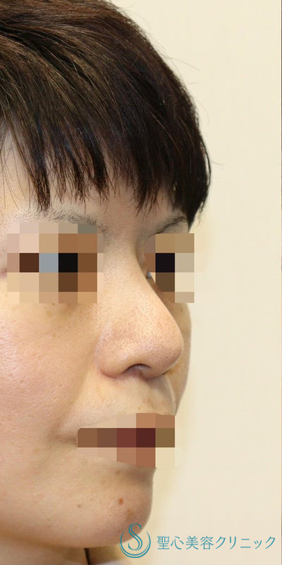 【40代女性・皮膚が厚く硬い方も綺麗にスッキリと】鼻中隔延長術（肋軟骨）＋鼻尖形成（肋軟骨）＋プロテーゼ（他院プロテーゼ入替）（術後7ヶ月） Before 