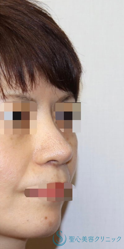 【40代女性・皮膚が厚く硬い方も綺麗にスッキリと】鼻中隔延長術（肋軟骨）＋鼻尖形成（肋軟骨）＋プロテーゼ（他院プロテーゼ入替）（術後7ヶ月） After 