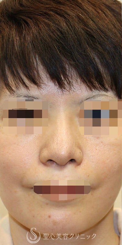 【40代女性・皮膚が厚く硬い方も綺麗にスッキリと】鼻中隔延長術（肋軟骨）＋鼻尖形成（肋軟骨）＋プロテーゼ（他院プロテーゼ入替）（術後7ヶ月） Before 