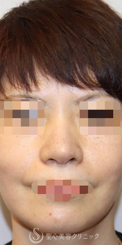 【40代女性・皮膚が厚く硬い方も綺麗にスッキリと】鼻中隔延長術（肋軟骨）＋鼻尖形成（肋軟骨）＋プロテーゼ（他院プロテーゼ入替）（術後7ヶ月） After 