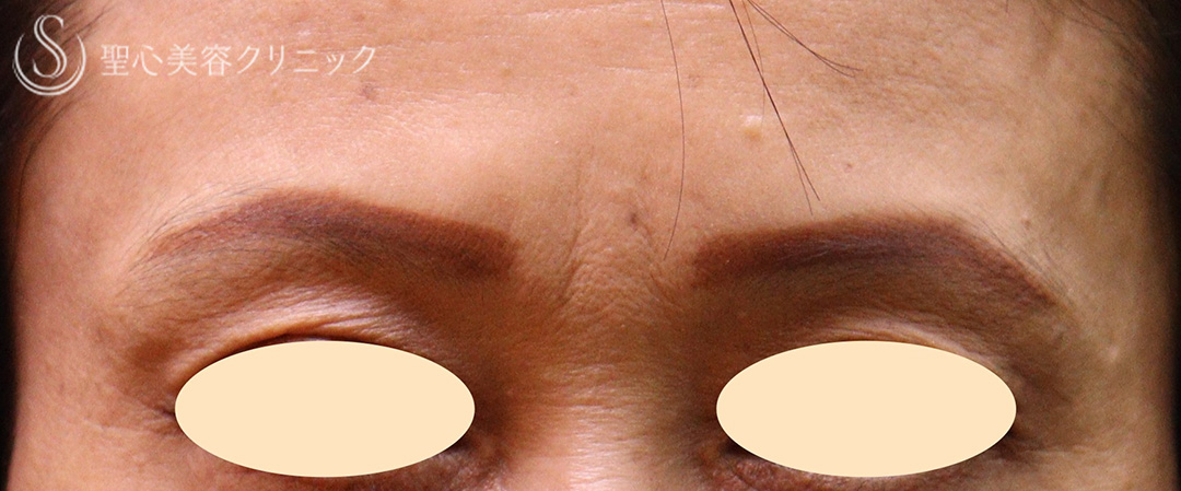 【50代女性・眉間のしわ】プレミアムPRP皮膚再生療法（1年3か月後） Before 