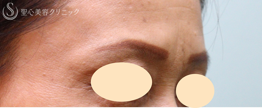 【50代女性・眉間のしわ】プレミアムPRP皮膚再生療法（1年3か月後） Before 