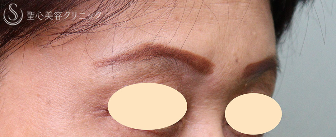 【50代女性・眉間のしわ】プレミアムPRP皮膚再生療法（1年3か月後） After 